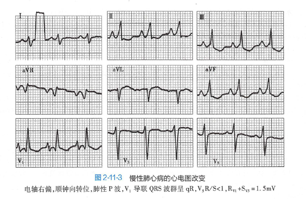 规培复习-呼吸系统-COPD+肺心病 规培复习-呼吸系统-COPD+肺心病