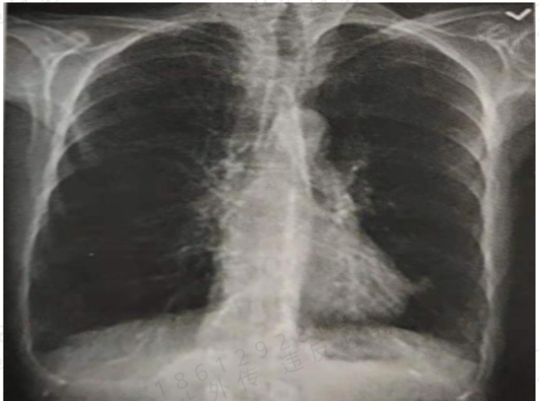 规培复习-呼吸系统-COPD+肺心病 规培复习-呼吸系统-COPD+肺心病