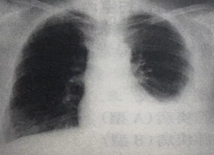 规培复习-呼吸-胸腔积液 规培复习-呼吸-胸腔积液